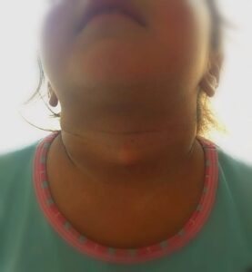 quiste tirogloso, tumor en cuello, masas en cuello, quiste congenito, cirugia niños